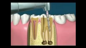 Video de endodoncia